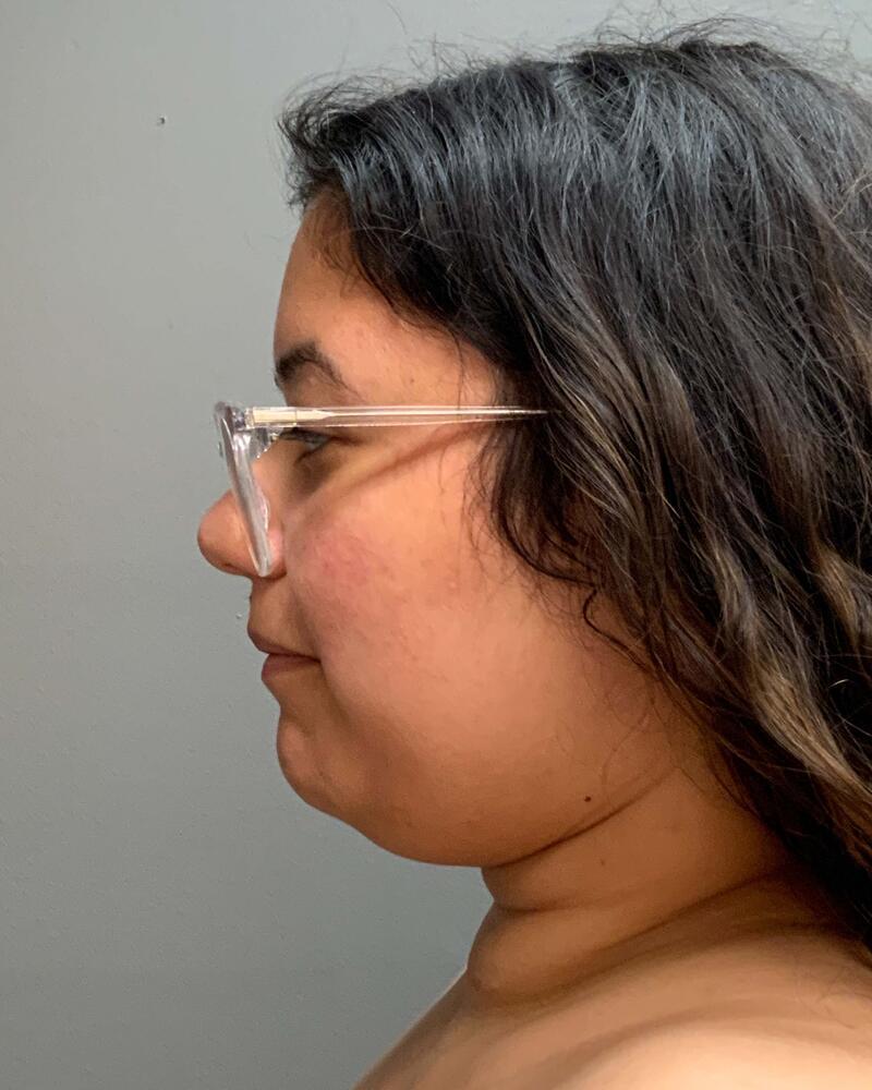 Chin Liposuction Before & After Image