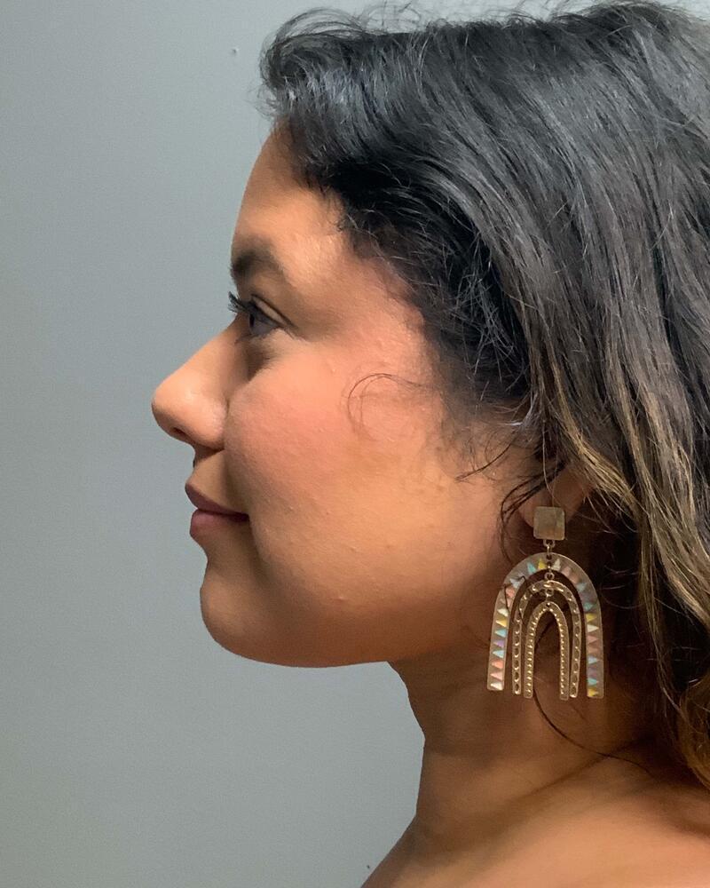 Chin Liposuction Before & After Image