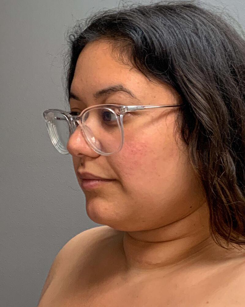 Chin Liposuction Before & After Image