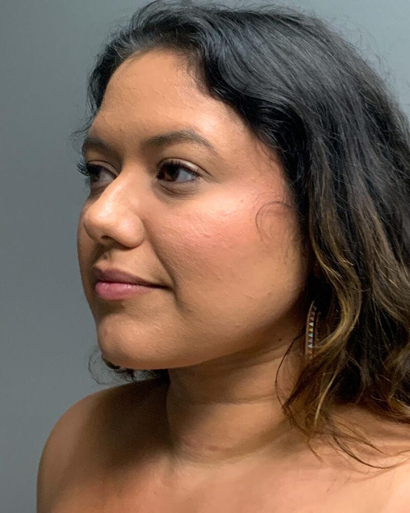 Chin Liposuction Before & After Image