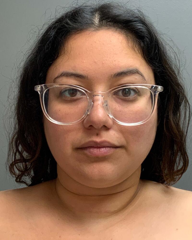 Chin Liposuction Before & After Image