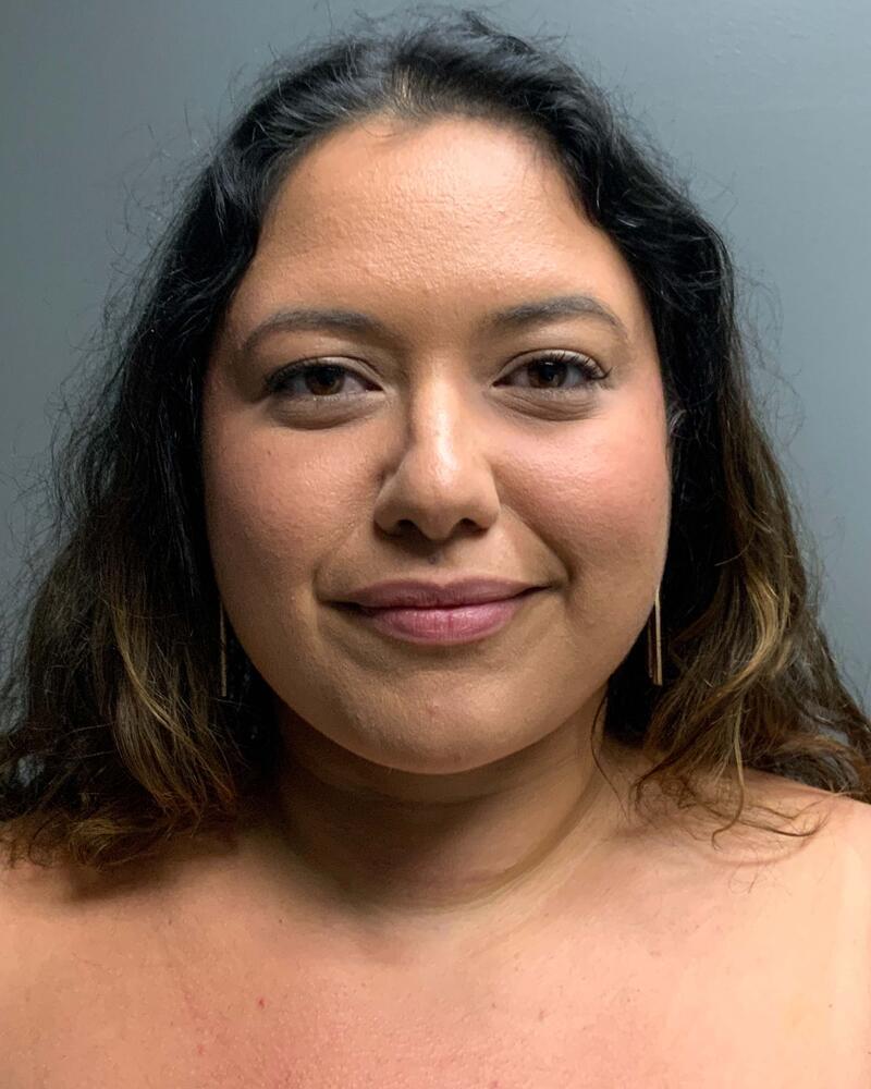 Chin Liposuction Before & After Image