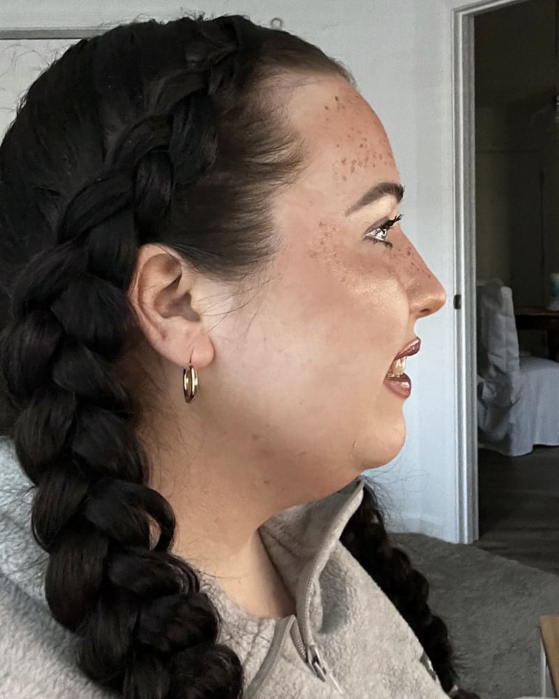 Chin Liposuction Before & After Image