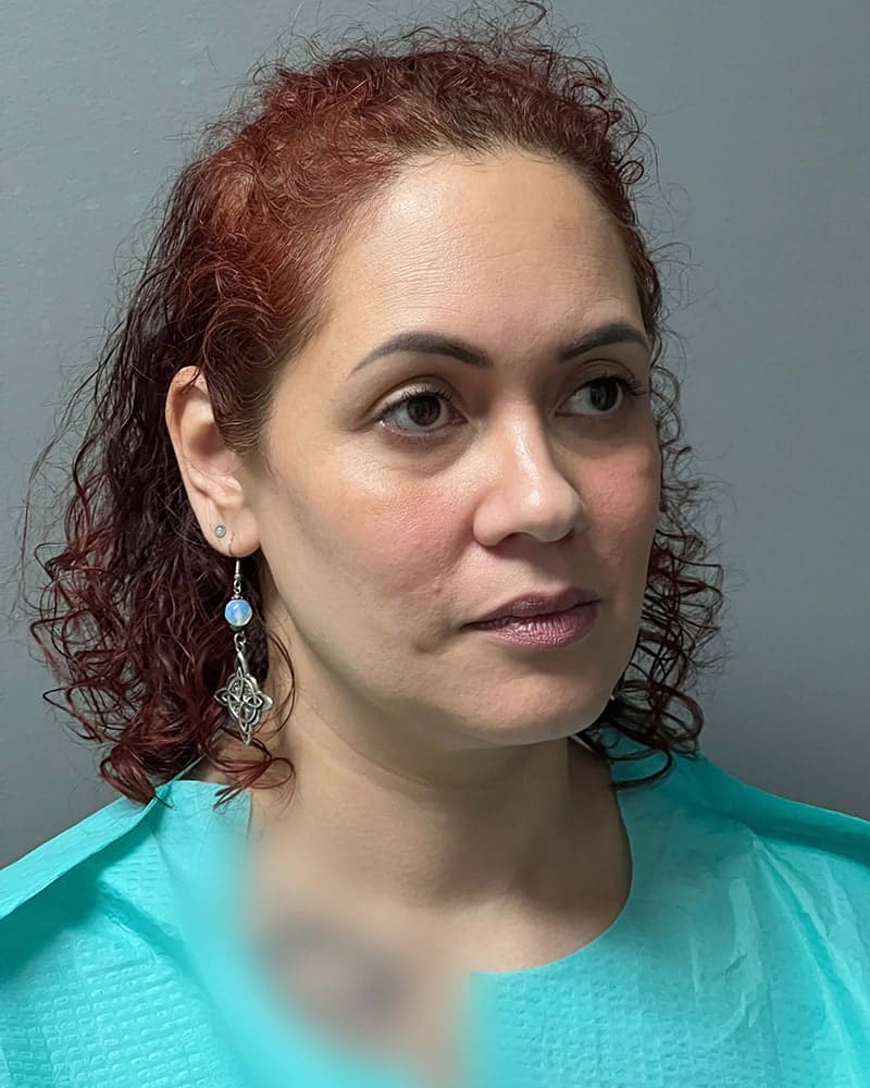 Chin Liposuction Before & After Image