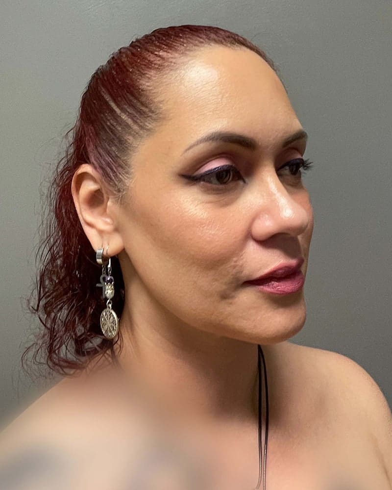 Chin Liposuction Before & After Image