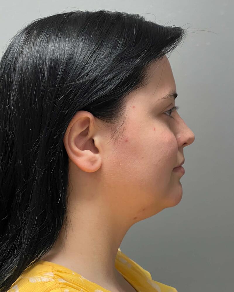 Chin Liposuction Before & After Image