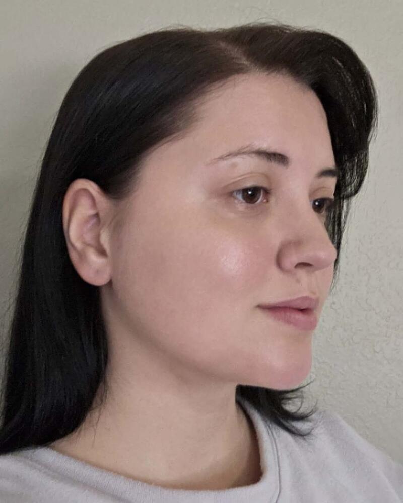 Chin Liposuction Before & After Image