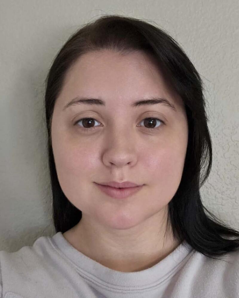 Chin Liposuction Before & After Image