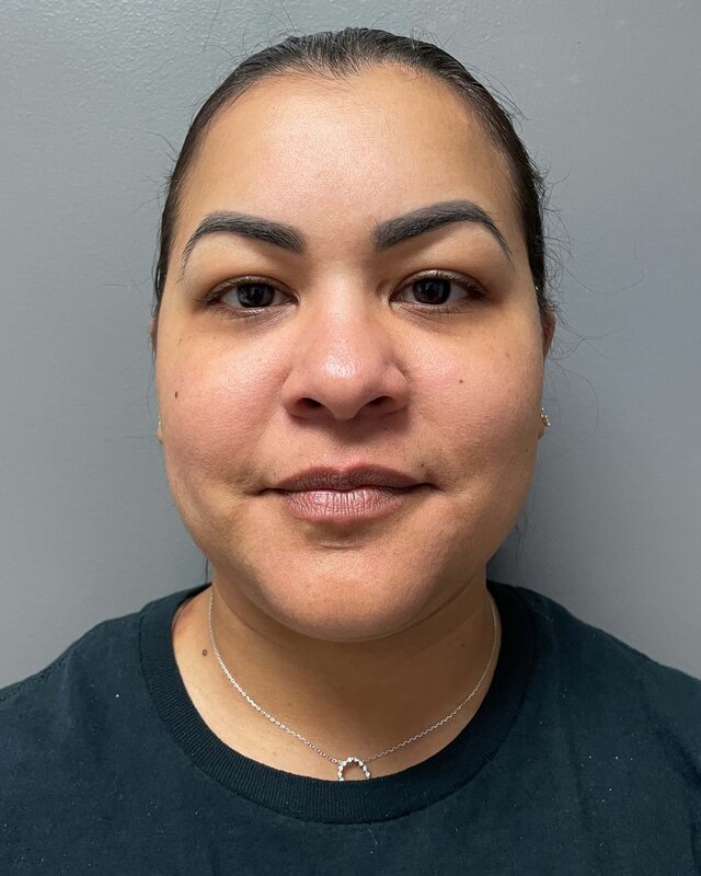 Chin Liposuction Before & After Image