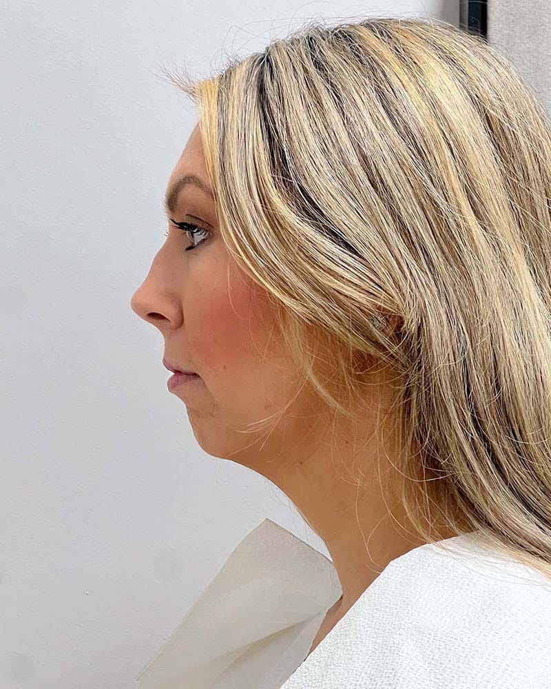 Chin Liposuction Before & After Image