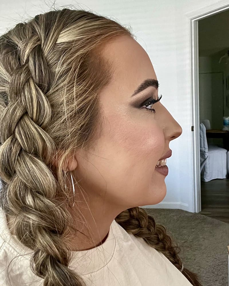 Chin Liposuction Before & After Image