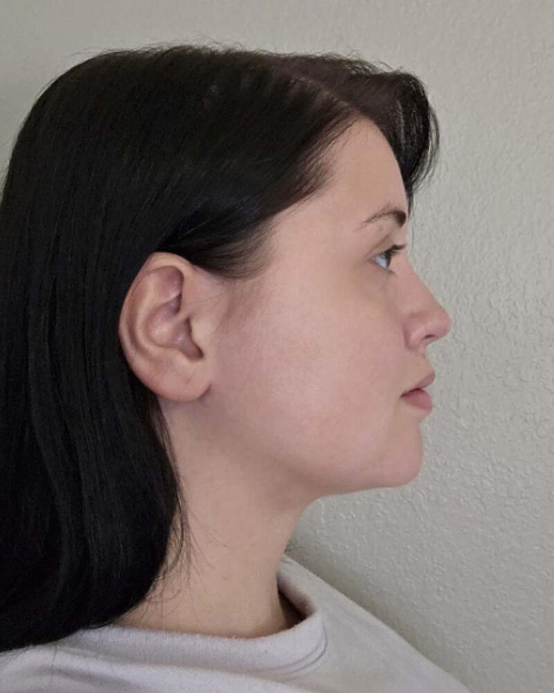 Chin Liposuction Before & After Image