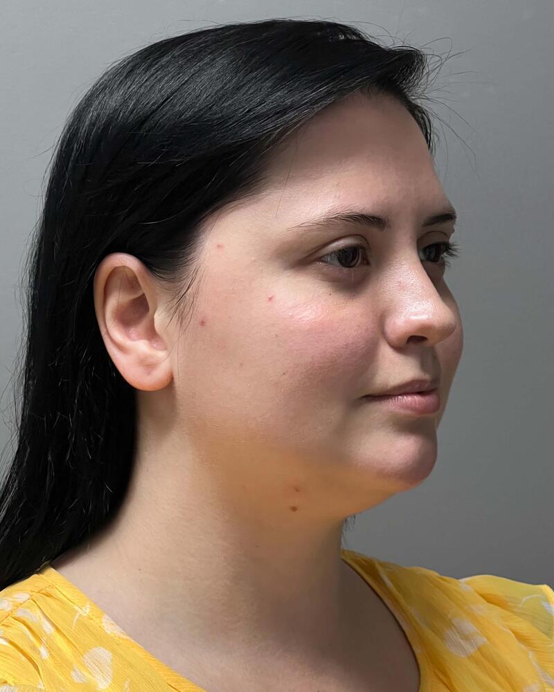 Chin Liposuction Before & After Image