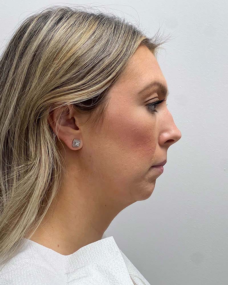 Chin Liposuction Before & After Image
