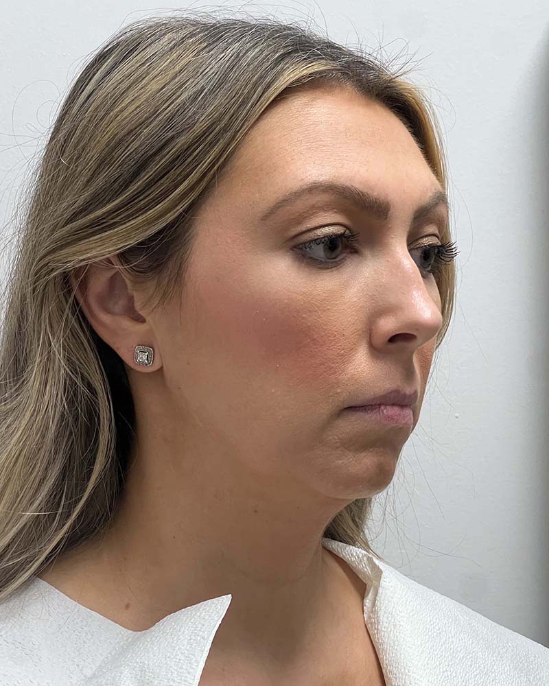 Chin Liposuction Before & After Image