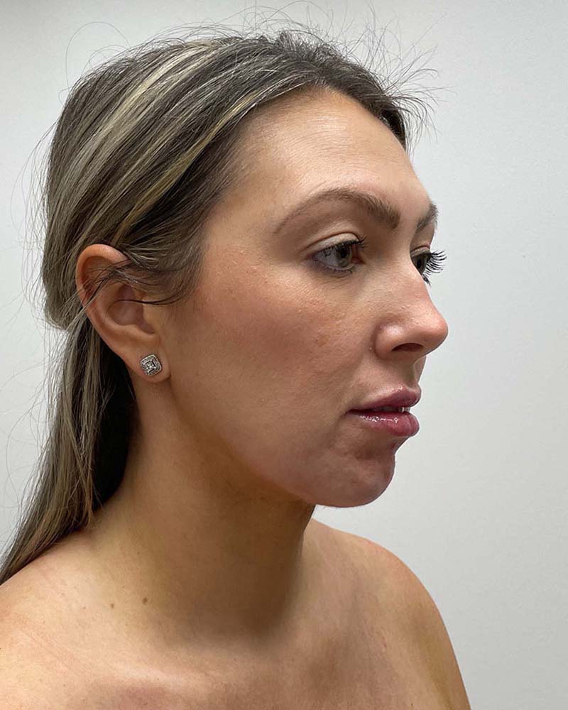 Chin Liposuction Before & After Image