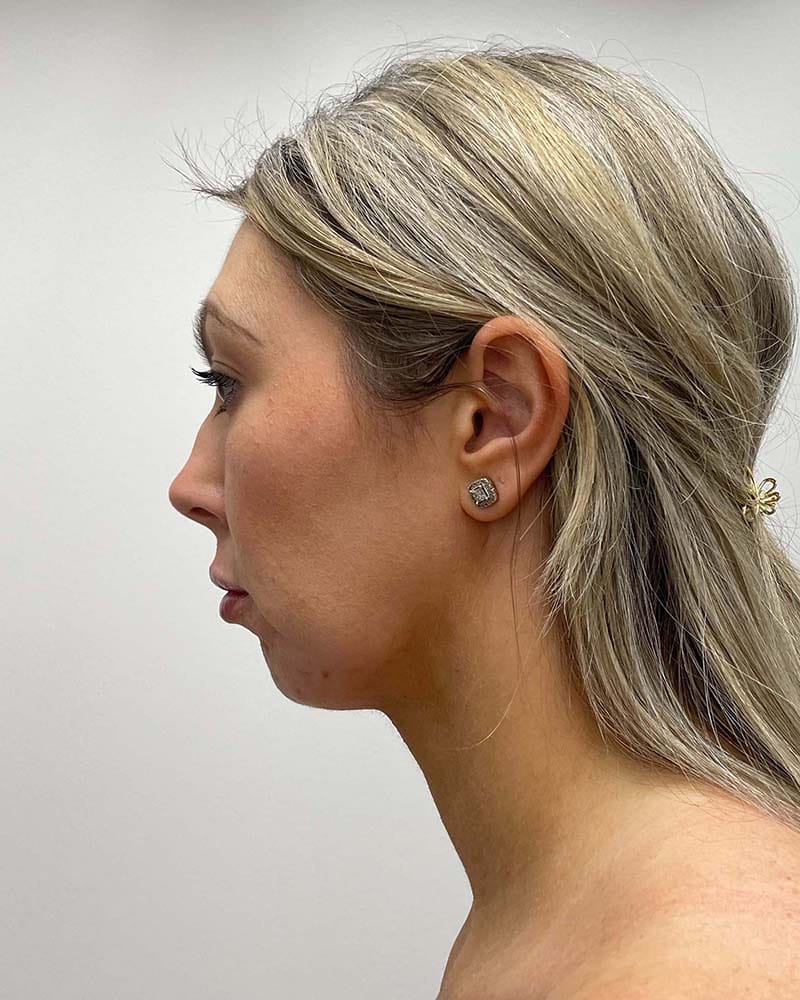 Chin Liposuction Before & After Image