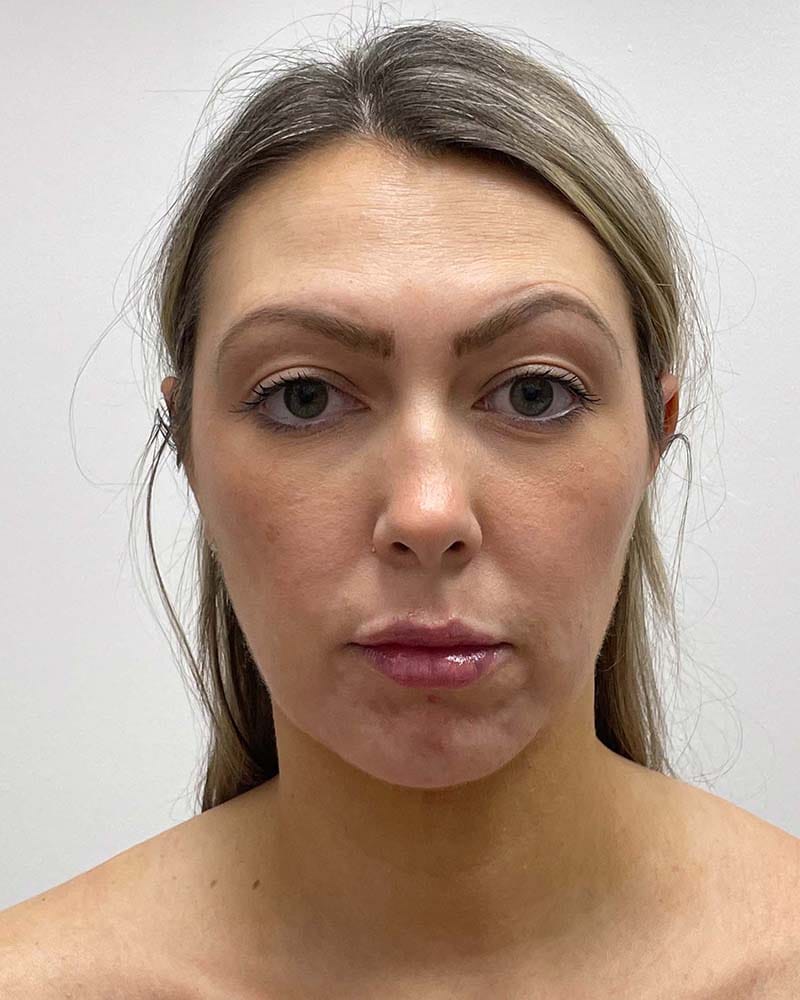 Chin Liposuction Before & After Image