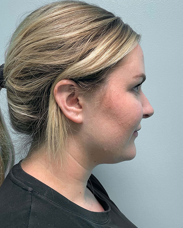 Sculptra Before & After Image