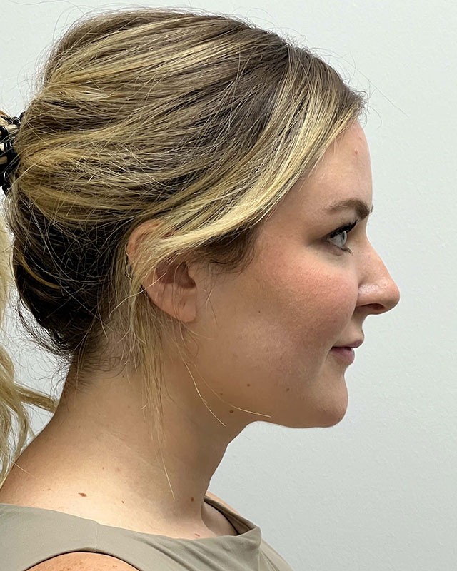 Sculptra Before & After Image