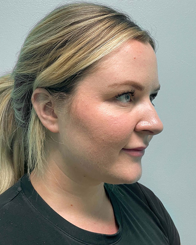 Chin Liposuction Before & After Image