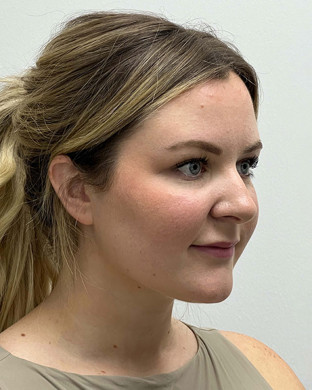 Chin Liposuction Before & After Image