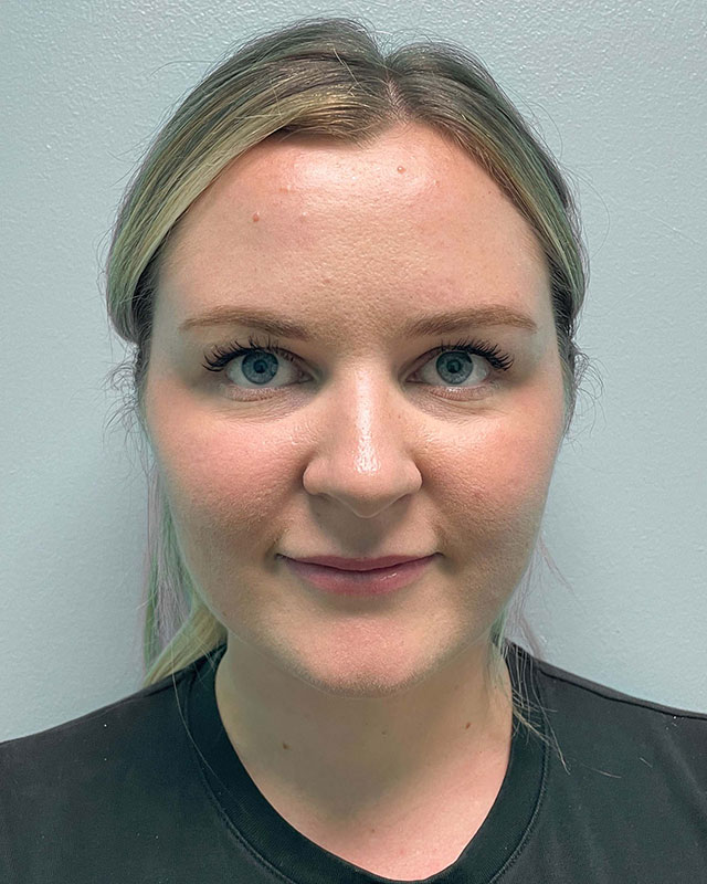 Chin Liposuction Before & After Image