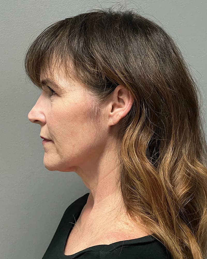 Facelift Before & After Image