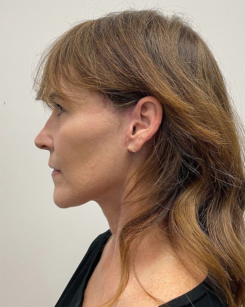 Facelift Before & After Image