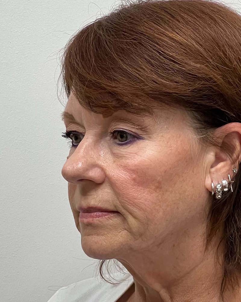 Facelift Before & After Image