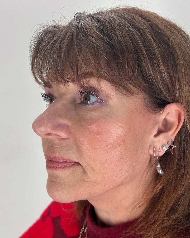 Facelift Before & After Image