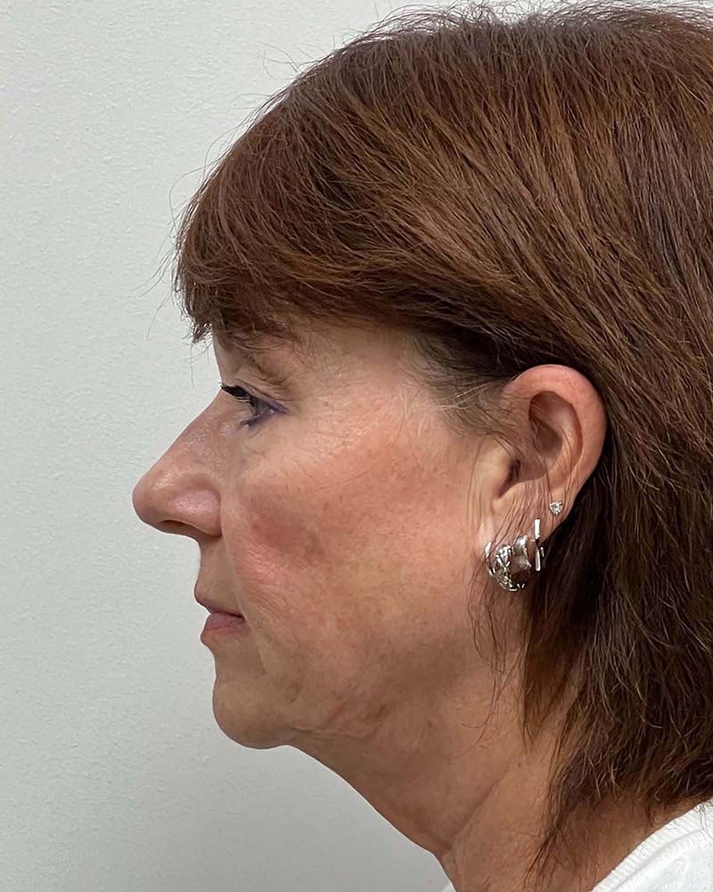 Facelift Before & After Image