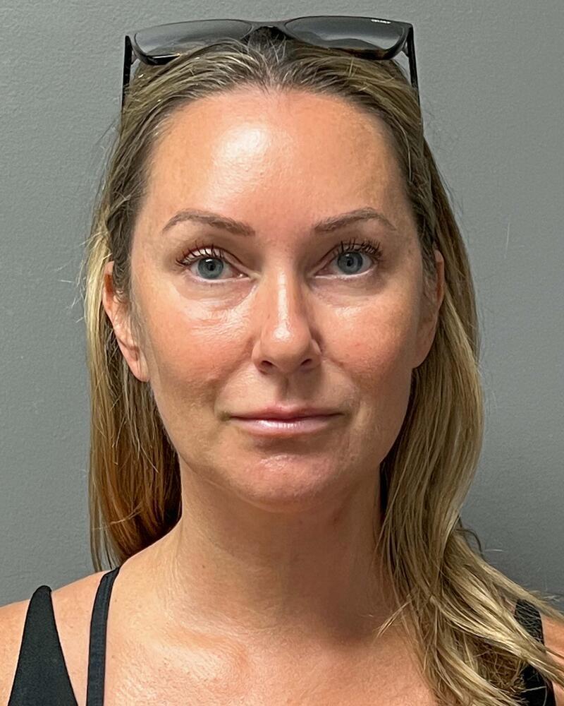 Facelift Before & After Image