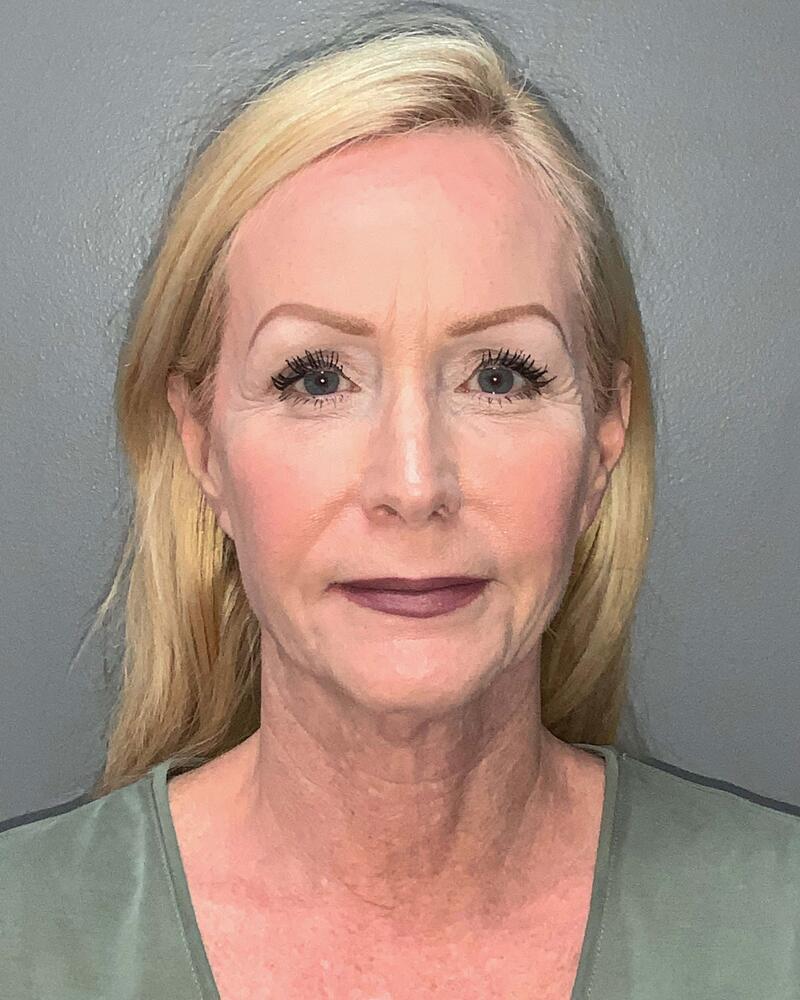 Facelift Before & After Image