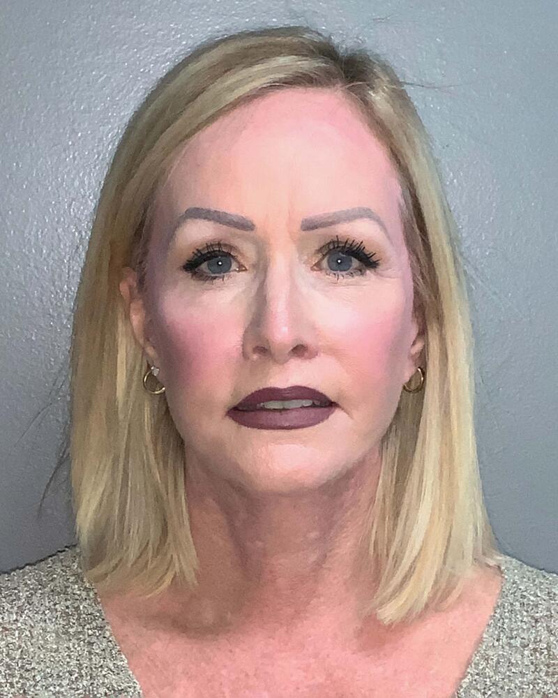 Facelift Before & After Image