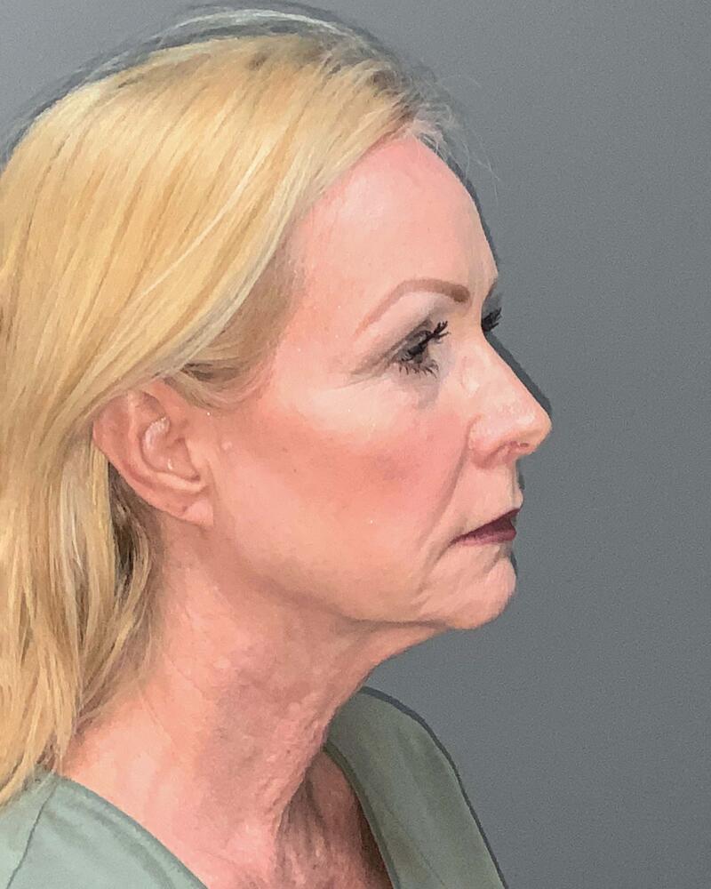 Facelift Before & After Image