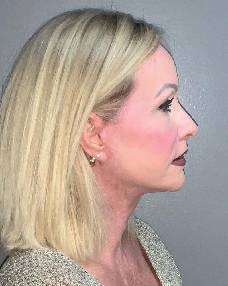 Facelift Before & After Image