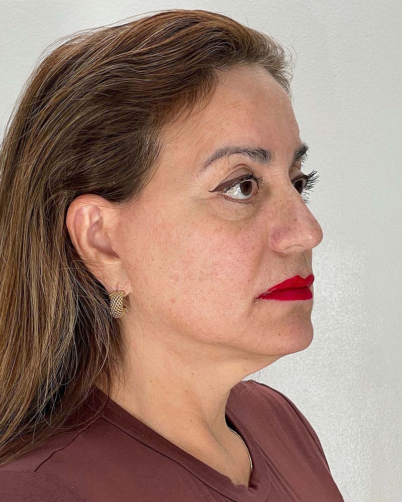 Facelift Before & After Image