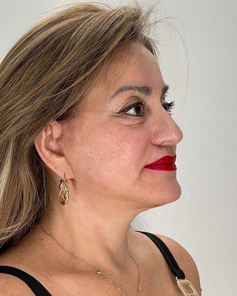 Facelift Before & After Image