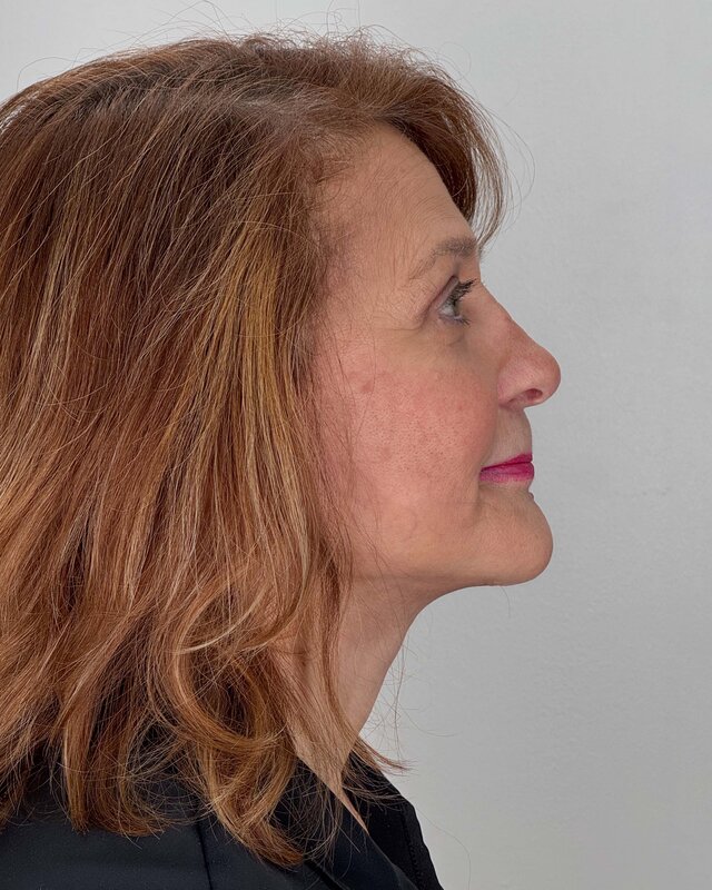 Facelift Before & After Image