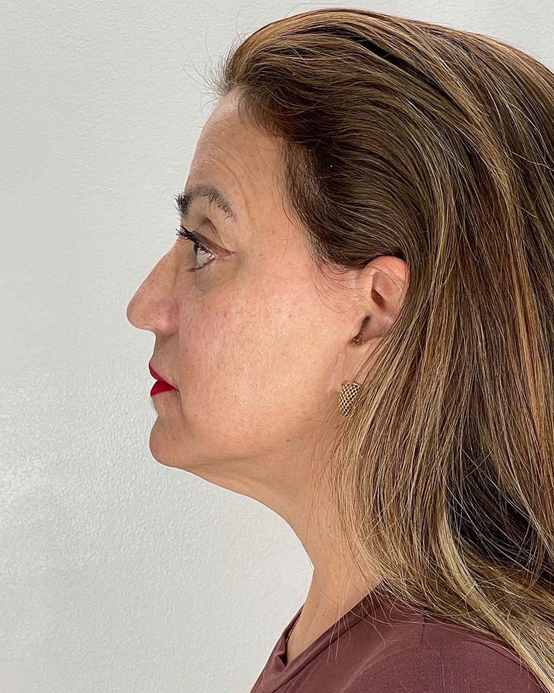 Facelift Before & After Image