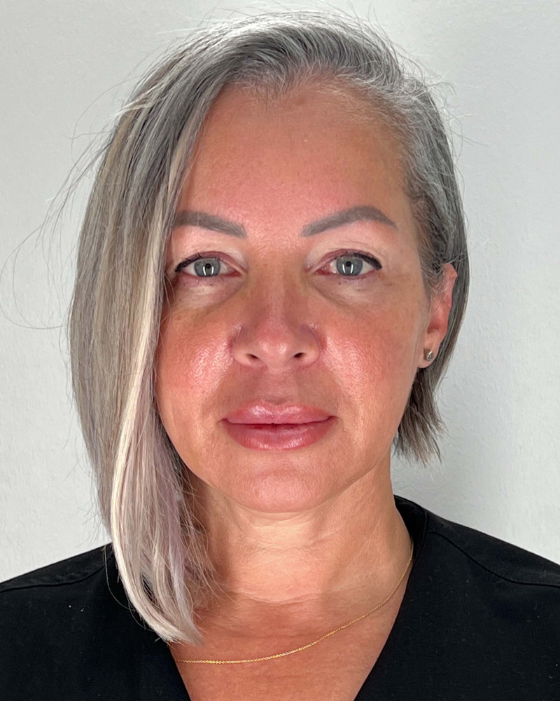 Facelift Before & After Image