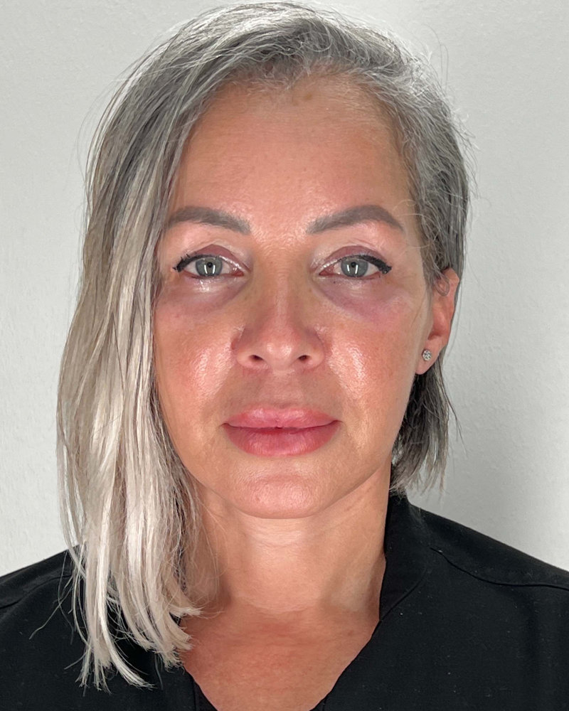 Facelift Before & After Image