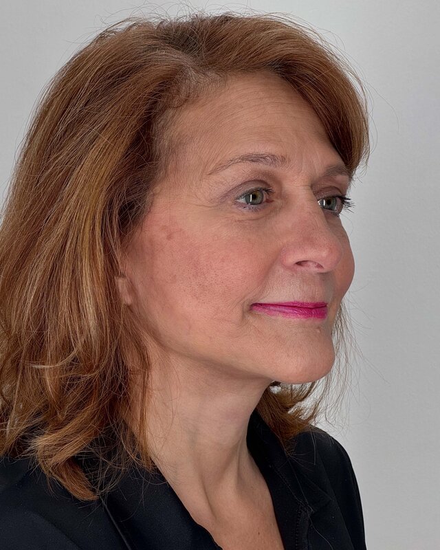 Facelift Before & After Image