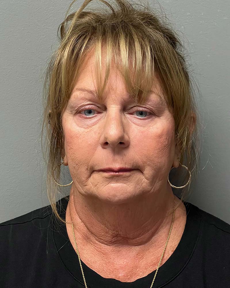 Facelift Before & After Image