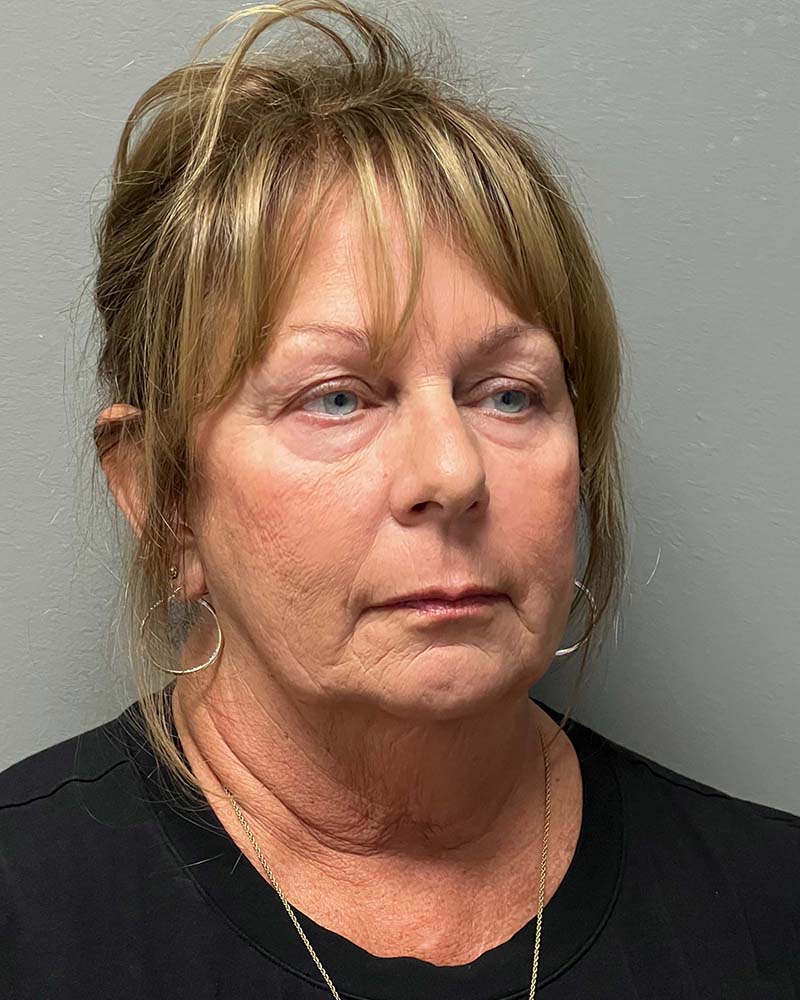 Facelift Before & After Image