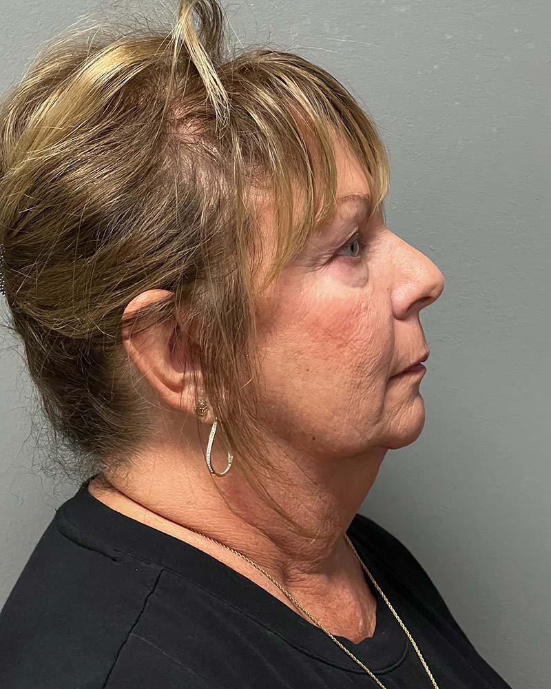 Facelift Before & After Image