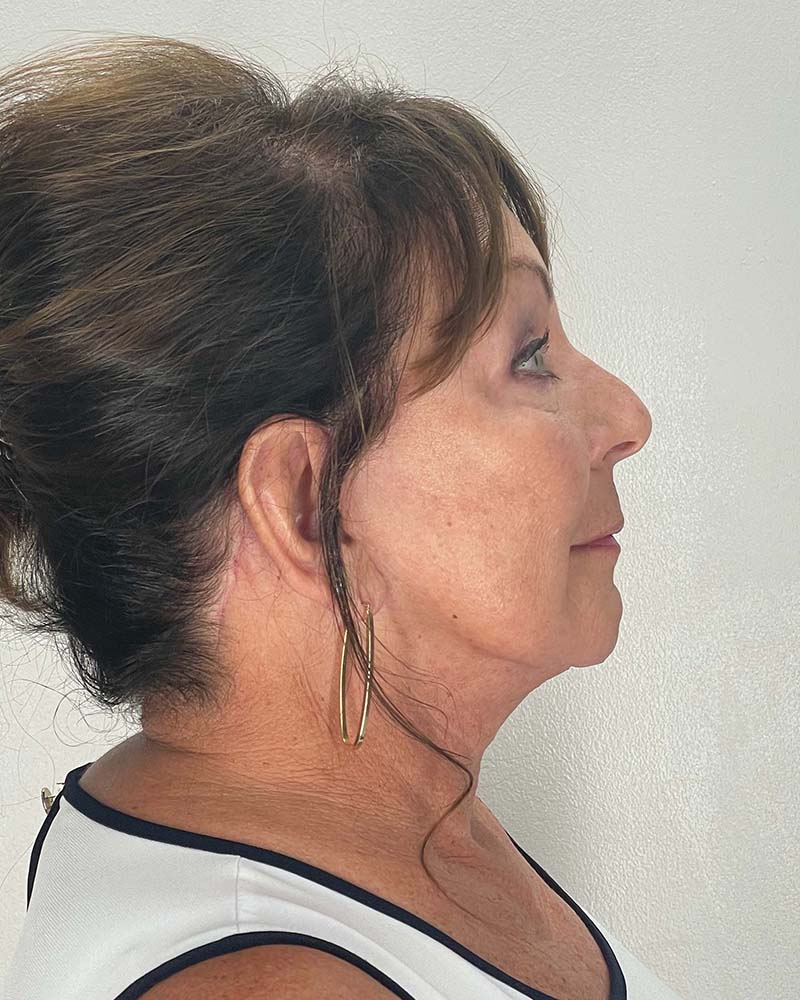 Facelift Before & After Image