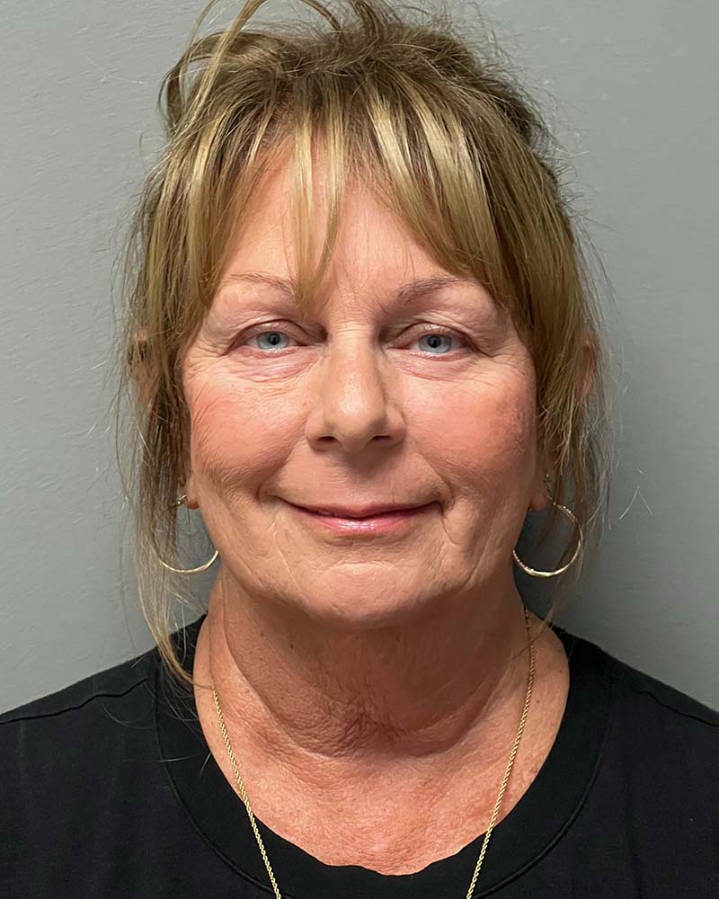 Facelift Before & After Image