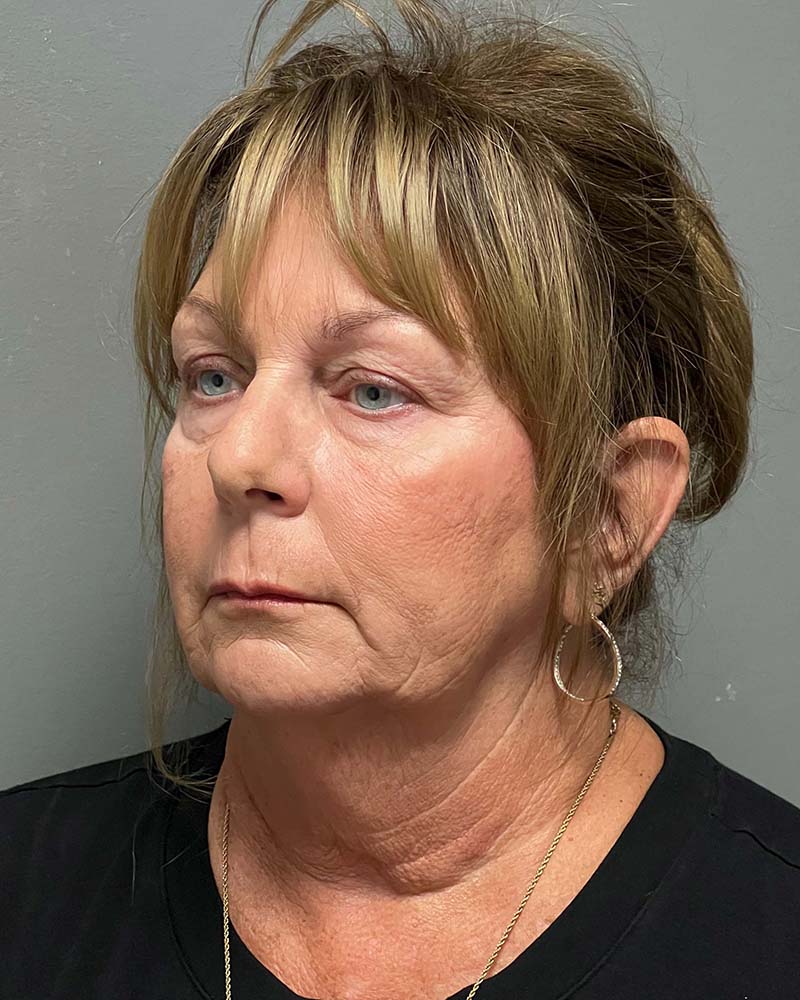 Facelift Before & After Image